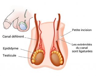 Lire la suite à propos de l’article Les trois méthodes modernes de contraception masculine