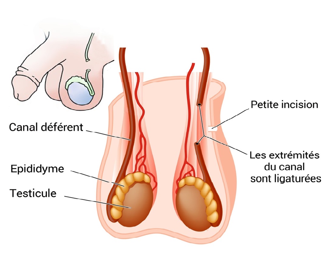 Lire la suite à propos de l’article Les trois méthodes modernes de contraception masculine