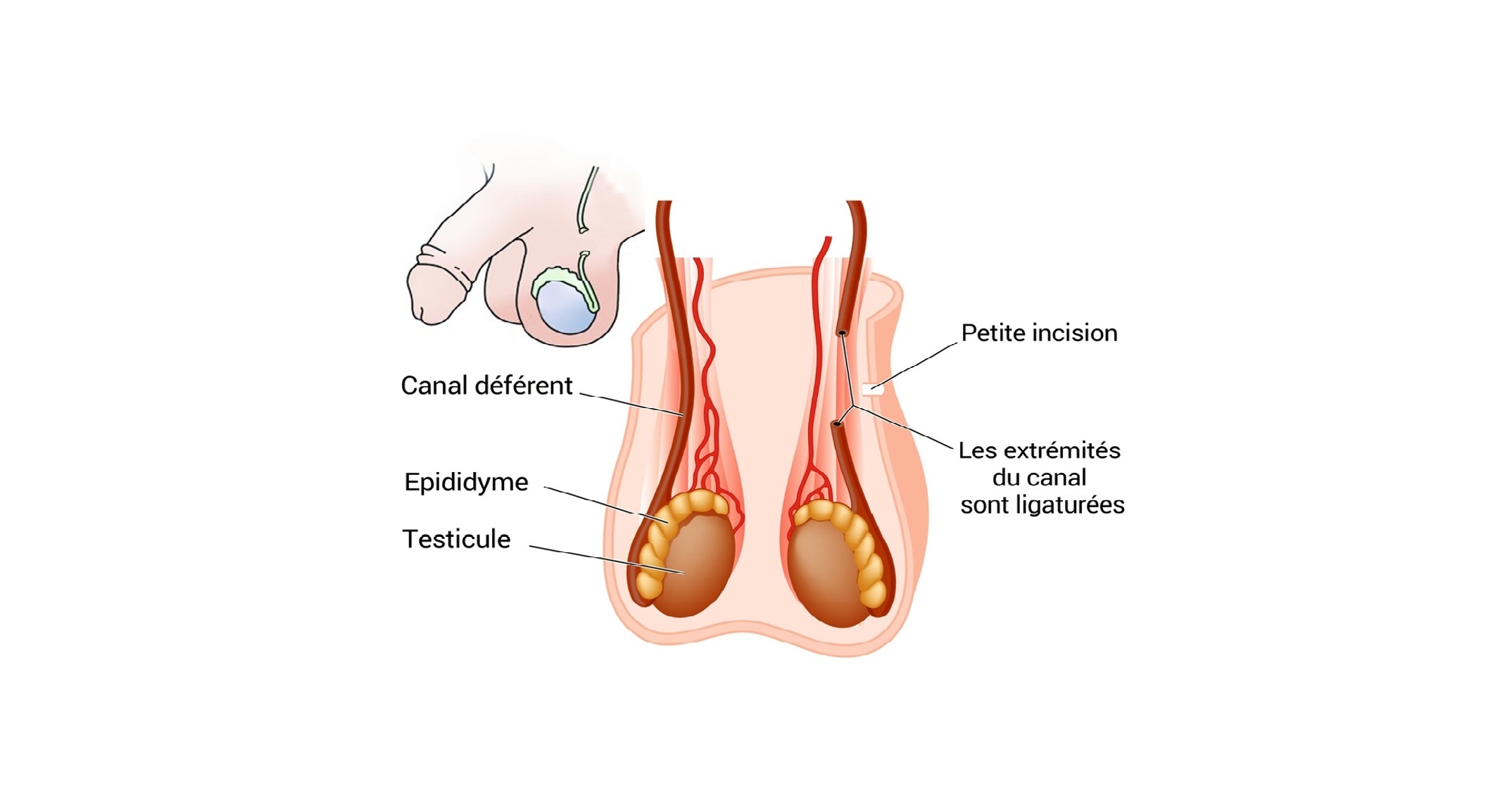 You are currently viewing Les trois méthodes modernes de contraception masculine